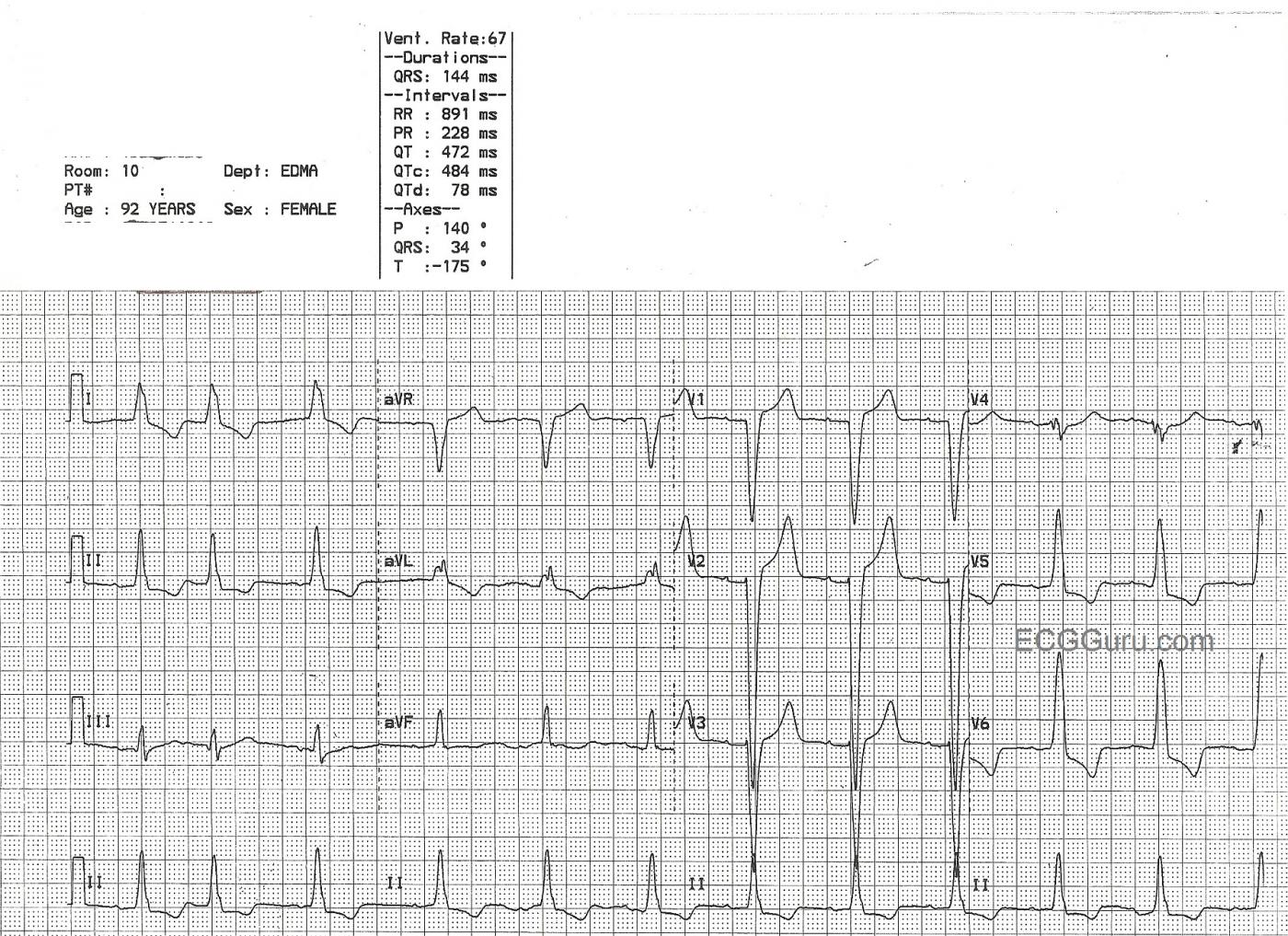 left-bundle-branch-block-and-left-ventricular-hypertrophy-ecg-porn